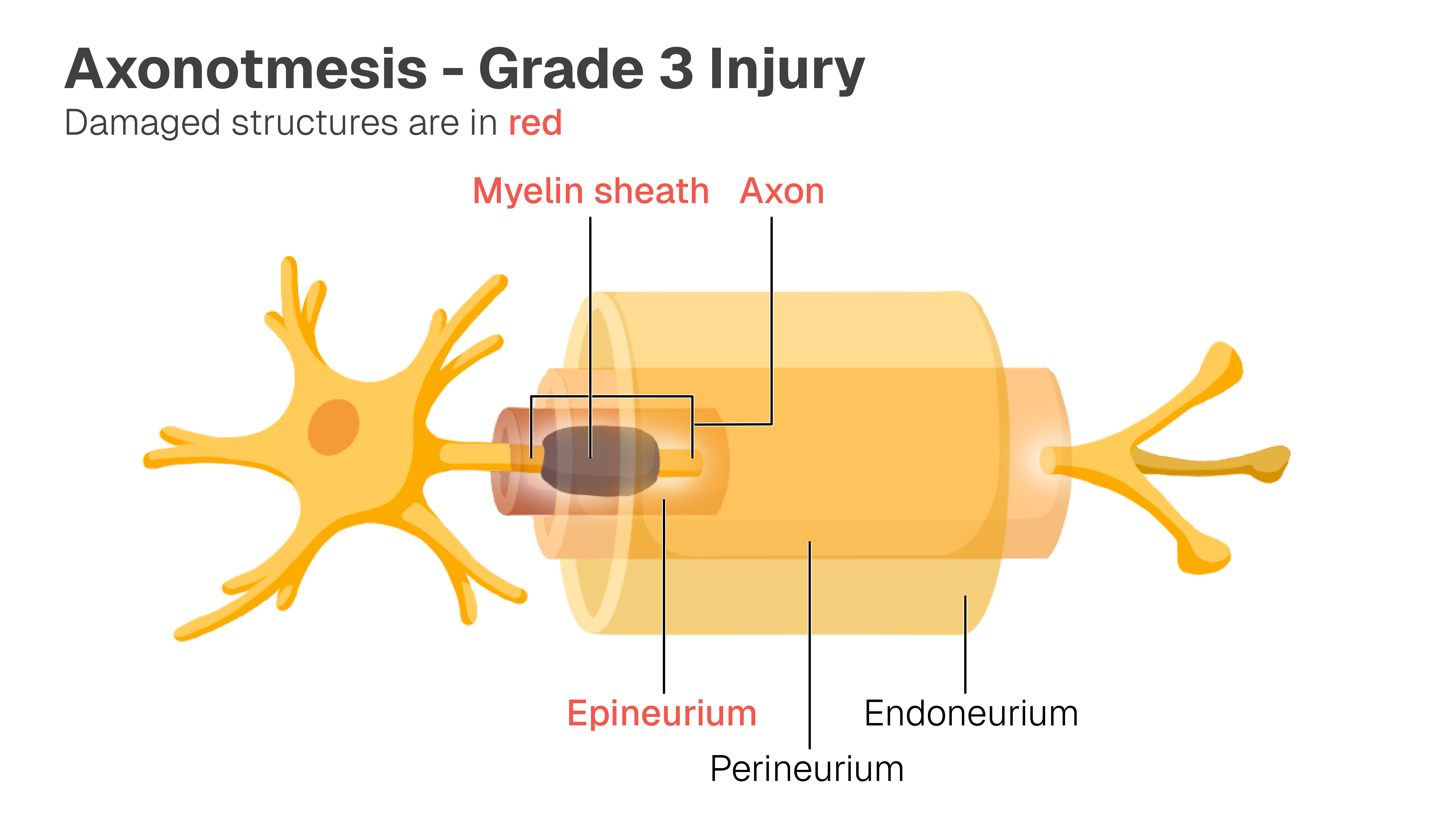 Image of normal neuron with the myelin sheath, axon, epineurium, perineurium, and endoneurium labelled. The myelin sheath, axon, and epineurium are damaged.